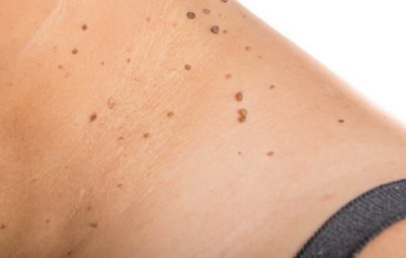 Acrocórdons em avaliação dermatológica na Clínica Remadê