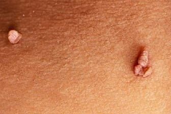 Fibroma mole em tratamento dermatológico na Clínica Remadê