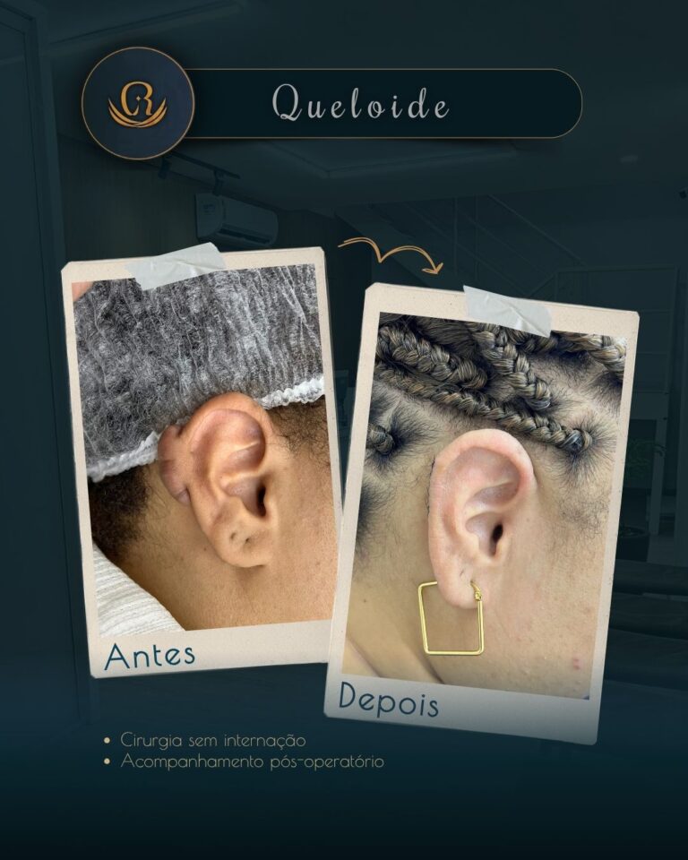 Queloide extensa na lateral da orelha em tratamento na Clínica Remadê