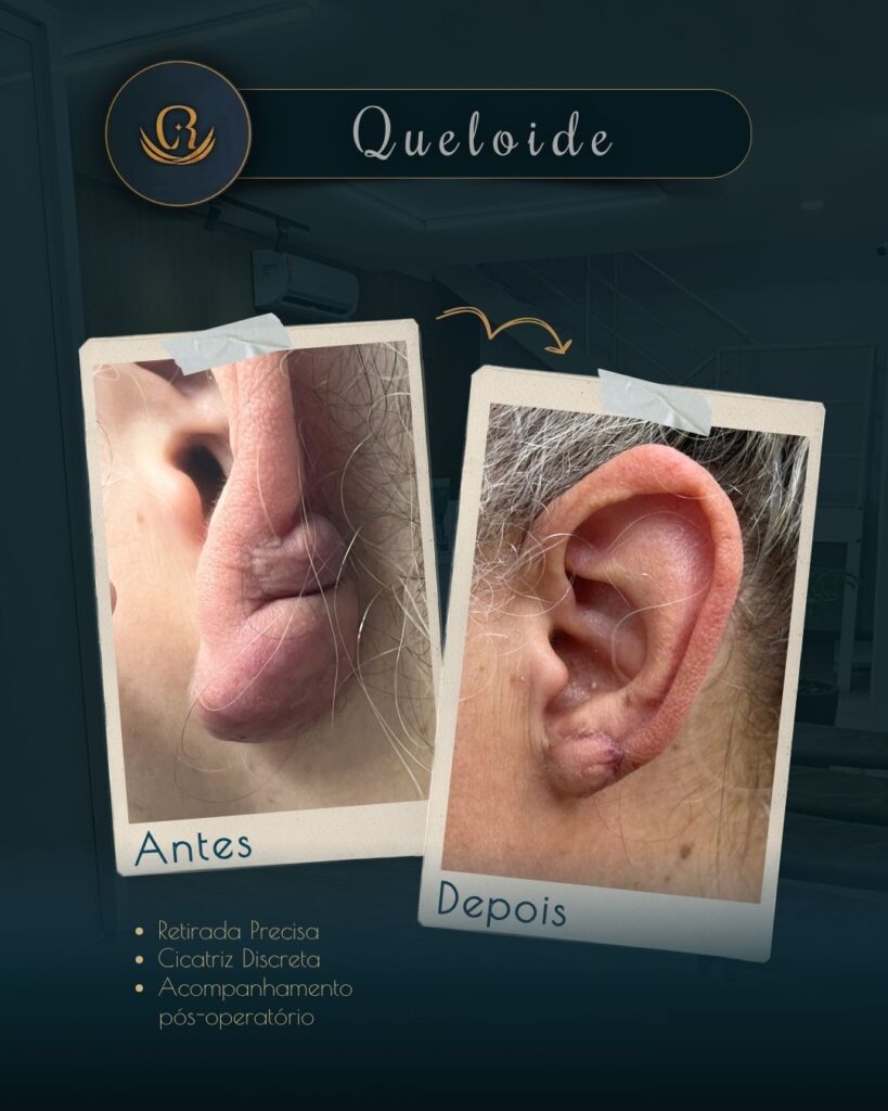 Reconstrução de orelha após deformidade auricular na Clínica Remadê