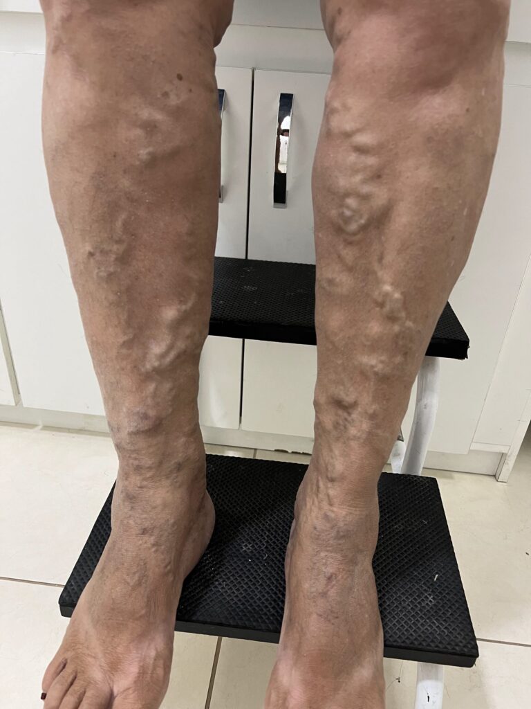 Paciente em pé com varizes em alto relevo nas duas pernas em avaliação na Clínica Remadê