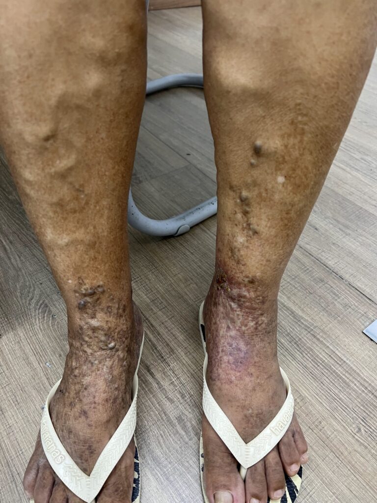 Pé e tornozelo com varizes aparentes e vasos dilatados em avaliação na Clínica Remadê