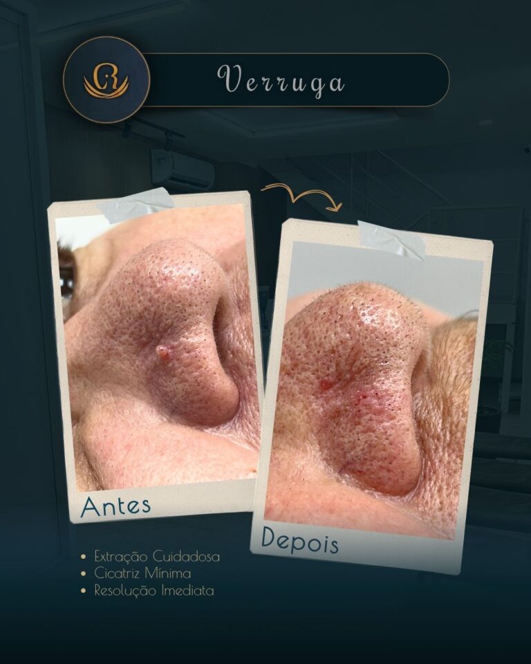 Verruga no nariz em atendimento dermatológico na Clínica Remadê