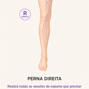 Tratamento de Espuma para Varizes — Perna Direita | Promoção 10 Anos