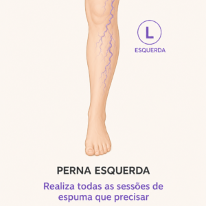 Tratamento de Espuma para Varizes — Perna Esquerda | Promoção 10 Anos