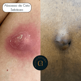 abscesso-cisto-sebaceo