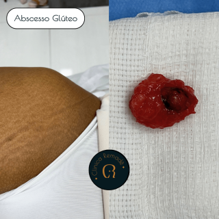 abscesso-gluteo