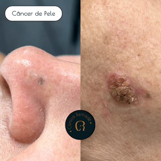 cancer-de-pele-facial