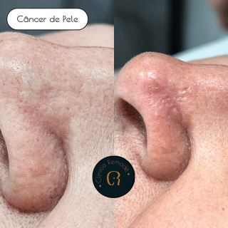 cancer-de-pele-nariz