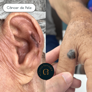 cancer-de-pele-orelha