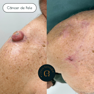 cancer-de-pele-resultado