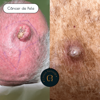 cancer-de-pele
