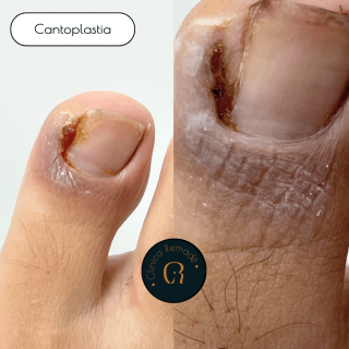 cantoplastia-resultado
