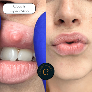 cicatriz-hipetrofica-labio