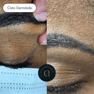 cisto-dermoide