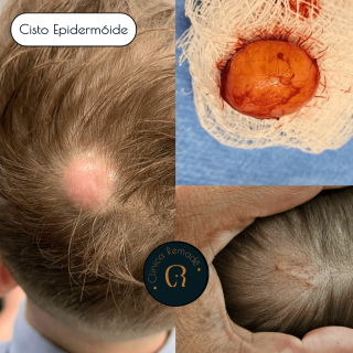 cisto-epidermoide-resultados