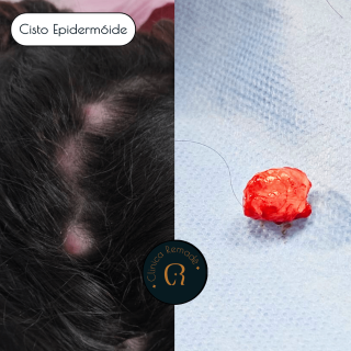 cisto-epidermoide-retirado