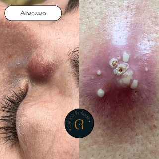 cisto-infectado-e-abscesso