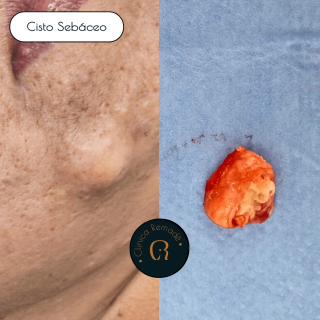 cisto-sebaceo-em-face