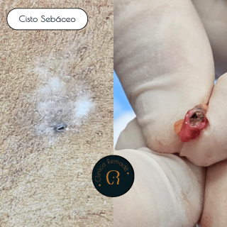 cisto-sebaceo-resultado