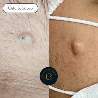 cisto-sebaceo