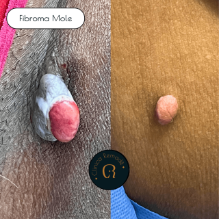 fibroma-mole-antes-da-retirada