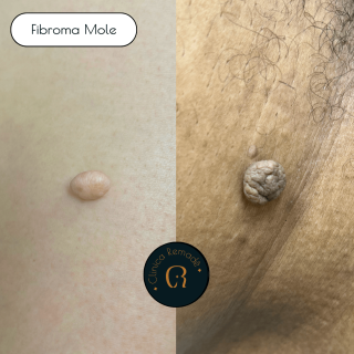 fibroma-mole-resultados-1