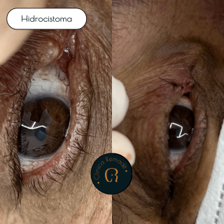 hidrocistoma-resultado