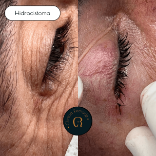 hidrocistoma-resultados