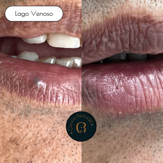 lago-venos-em-labio