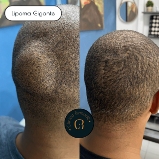 lipoma-gigante-na-cabeca