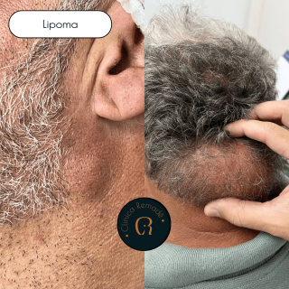 lipoma-gigante-pescoco