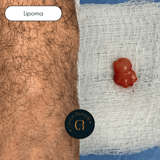 lipoma-na-mao