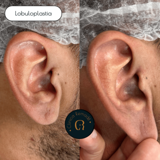 lobuloplastia-reducao-orelha