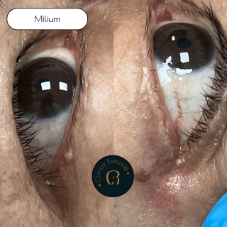 milium