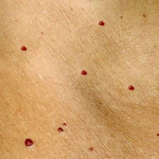Nevo rubi em avaliação dermatológica na Clínica Remadê