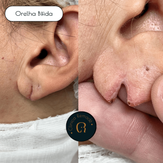 orelha-bifida