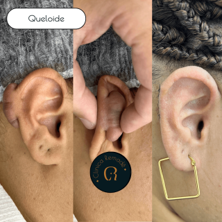 queloide-gigante-em-orelha