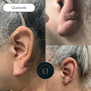 queloide-gigante-retalho-resultado
