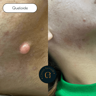 queloide-retirada-cirurgia-resultado