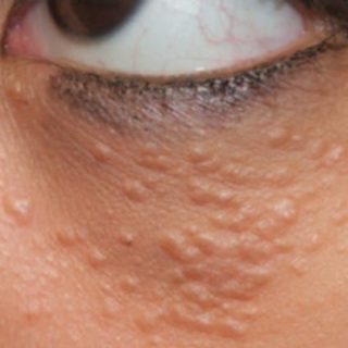 Siringoma na região dos olhos em avaliação na Clínica Remadê