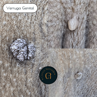 verruga-genital-hpv-papiloma