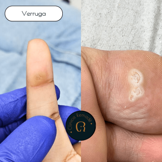 verruga-hpv-dedo-e-plantar