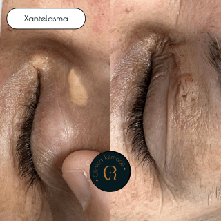 xantelasma-resultados